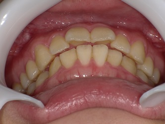 スプリント（ナイトガード）